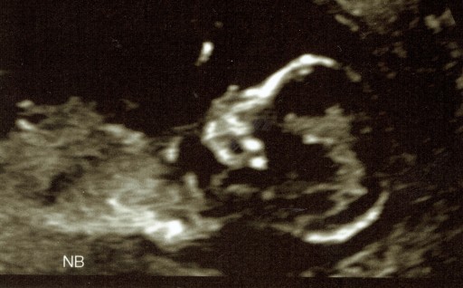 Baby Ultrasound #3, 20141021